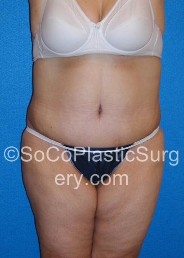 Tummy Tuck Before & After Gallery - Patient 8286197 - Image 2