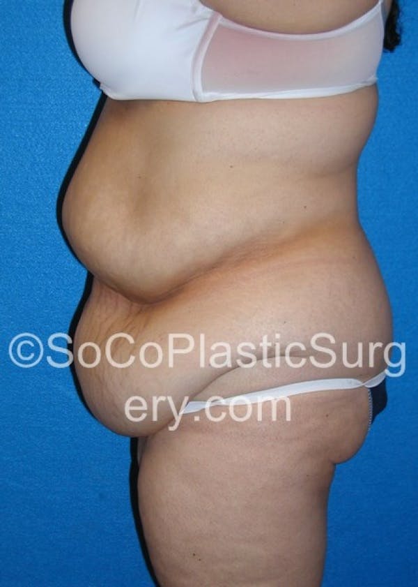 Tummy Tuck Before & After Gallery - Patient 8286197 - Image 3