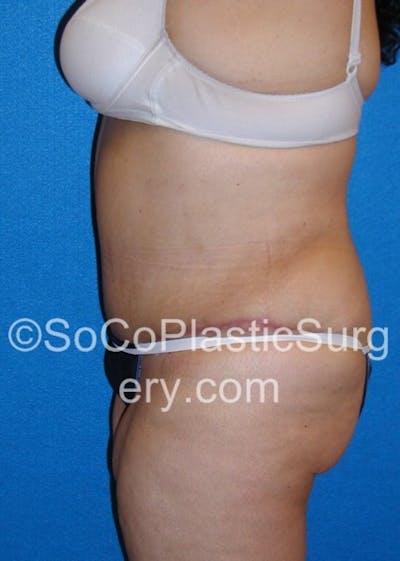 Tummy Tuck Before & After Gallery - Patient 8286197 - Image 4