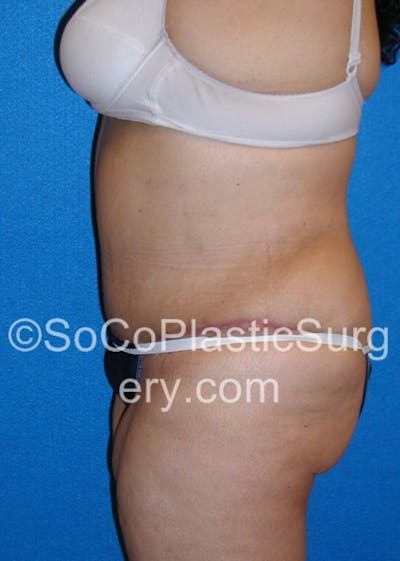 Tummy Tuck Before & After Gallery - Patient 8286197 - Image 4