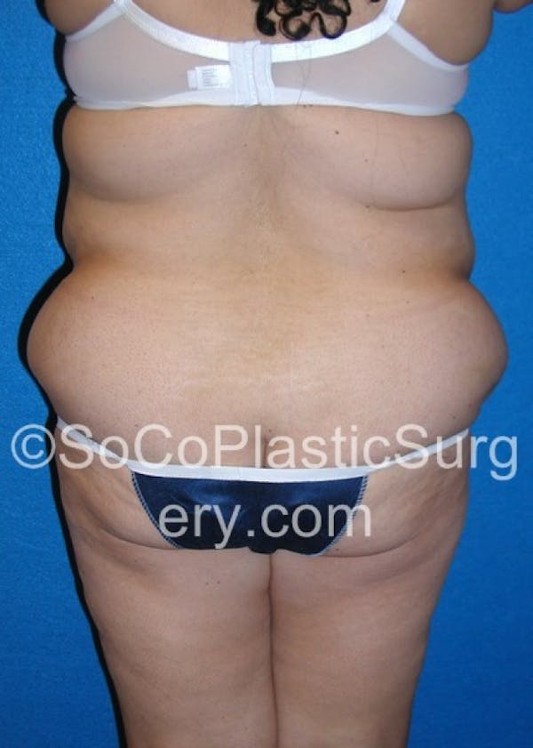 Tummy Tuck Before & After Gallery - Patient 8286197 - Image 5