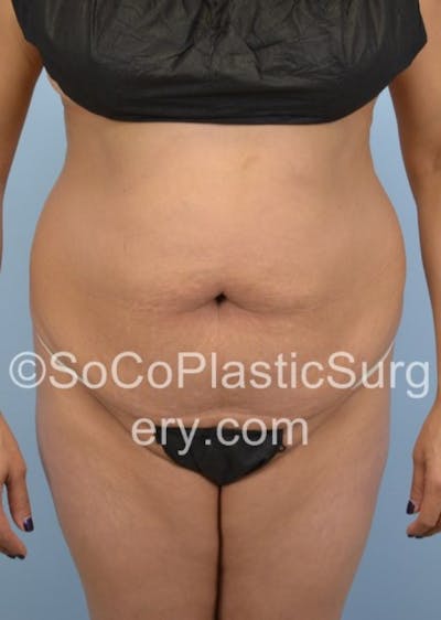 Tummy Tuck Before & After Gallery - Patient 8286198 - Image 1