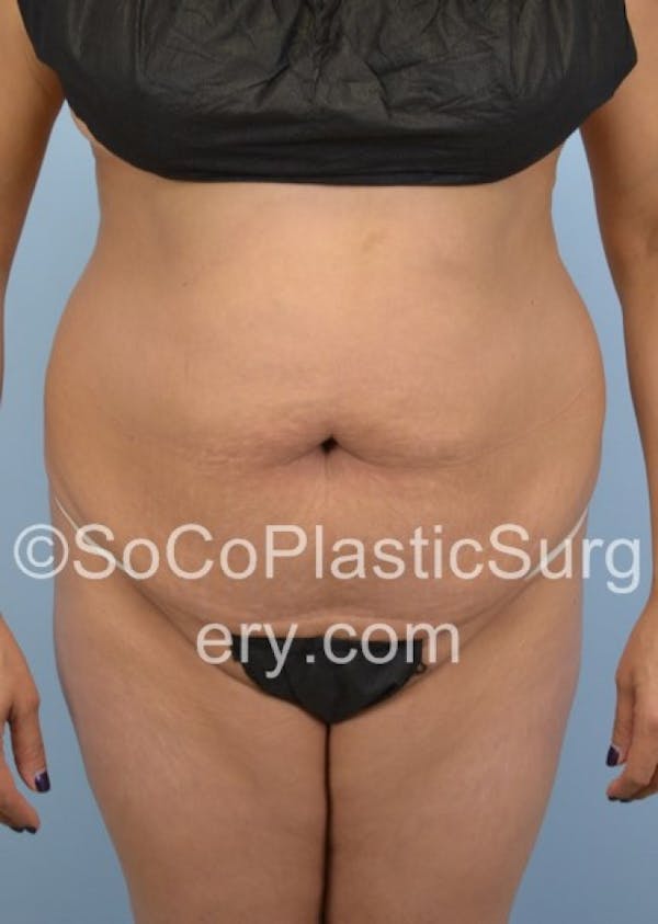 Tummy Tuck Before & After Gallery - Patient 8286198 - Image 1