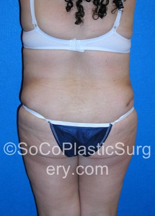 Tummy Tuck Before & After Gallery - Patient 8286197 - Image 6