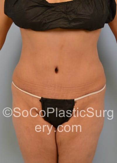 Tummy Tuck Before & After Gallery - Patient 8286198 - Image 2