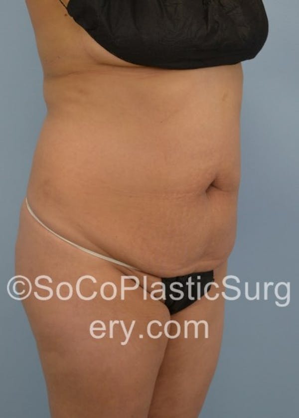 Tummy Tuck Before & After Gallery - Patient 8286198 - Image 3