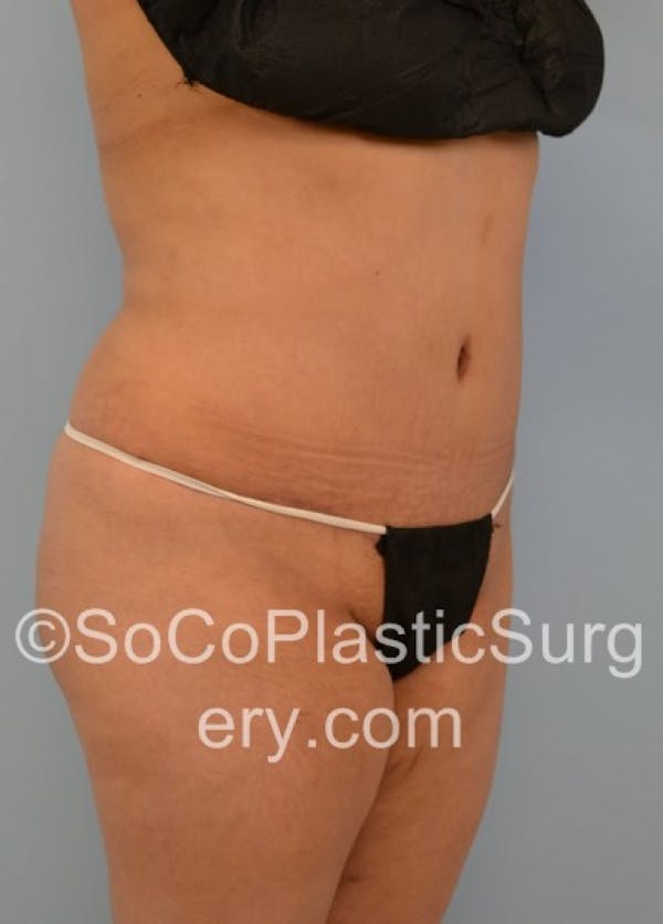 Tummy Tuck Before & After Gallery - Patient 8286198 - Image 4