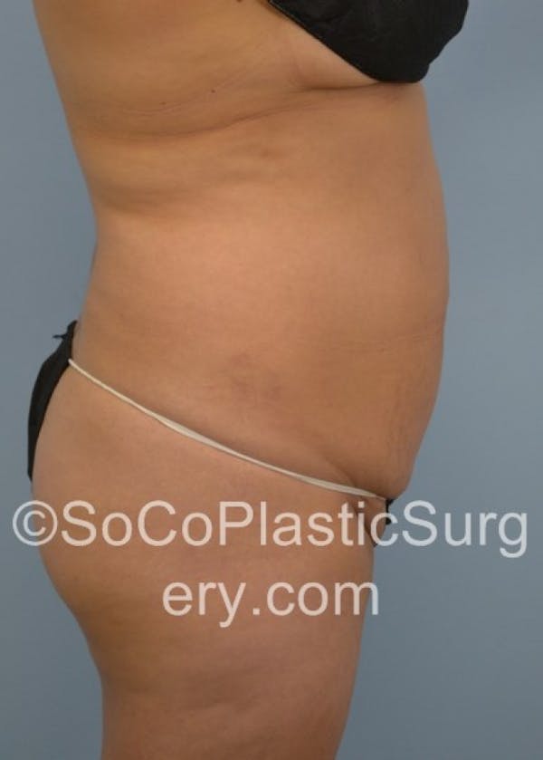 Tummy Tuck Before & After Gallery - Patient 8286198 - Image 5