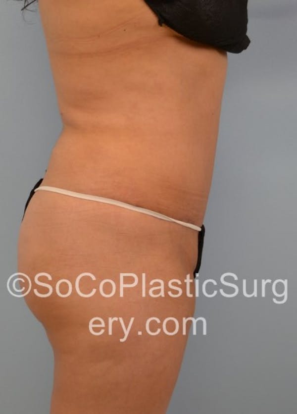 Tummy Tuck Before & After Gallery - Patient 8286198 - Image 6
