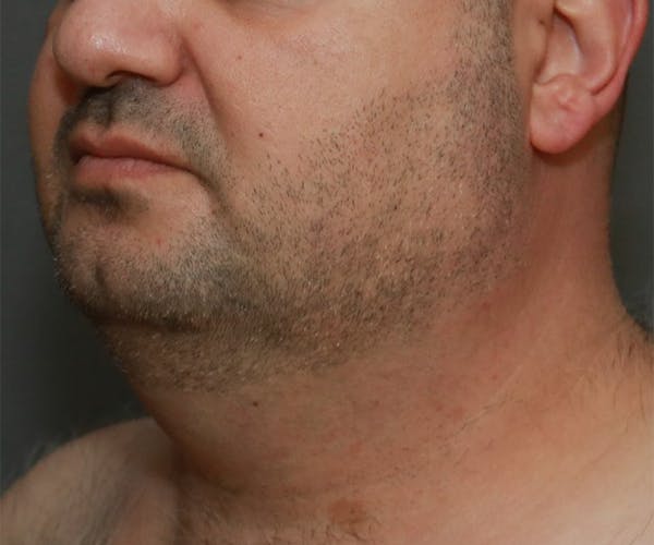 Double Chin (Submental Liposuction) Before & After Gallery - Patient 14777981 - Image 1