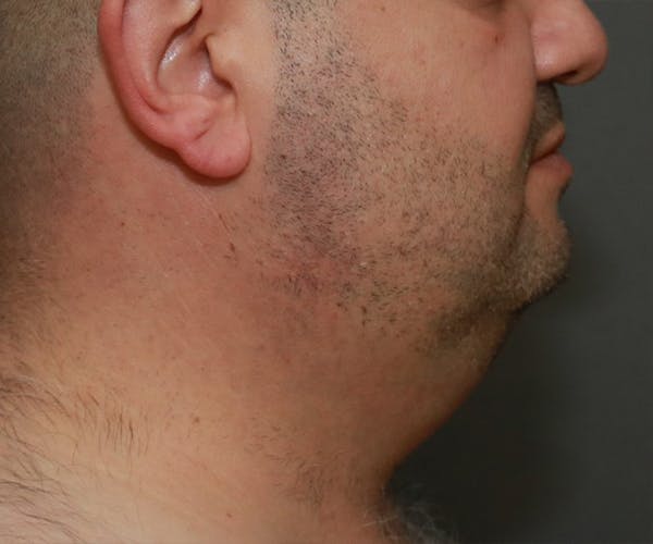 Double Chin (Submental Liposuction) Before & After Gallery - Patient 14777981 - Image 3
