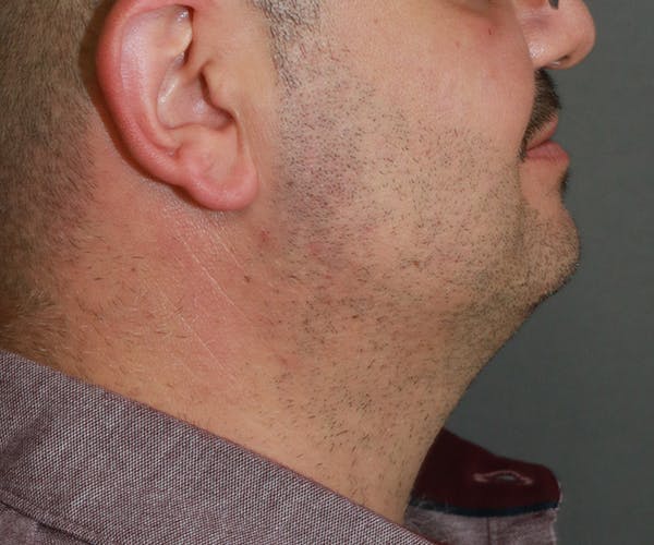 Double Chin (Submental Liposuction) Before & After Gallery - Patient 14777981 - Image 4