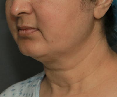 Double Chin (Submental Liposuction) Before & After Gallery - Patient 14777983 - Image 1