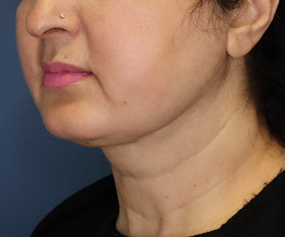 Double Chin (Submental Liposuction) Before & After Gallery - Patient 14777983 - Image 2