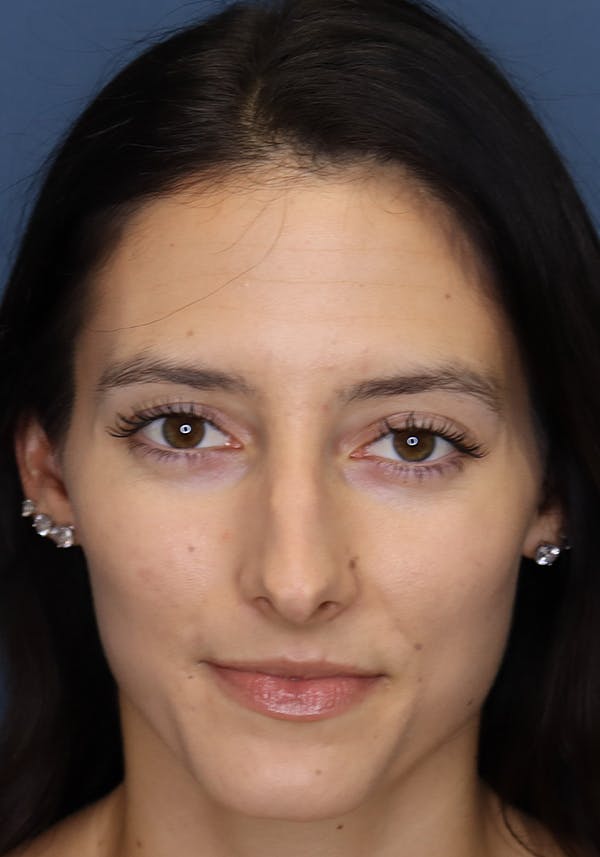 Aesthetic Rhinoplasty Before & After Gallery - Patient 14969149 - Image 1