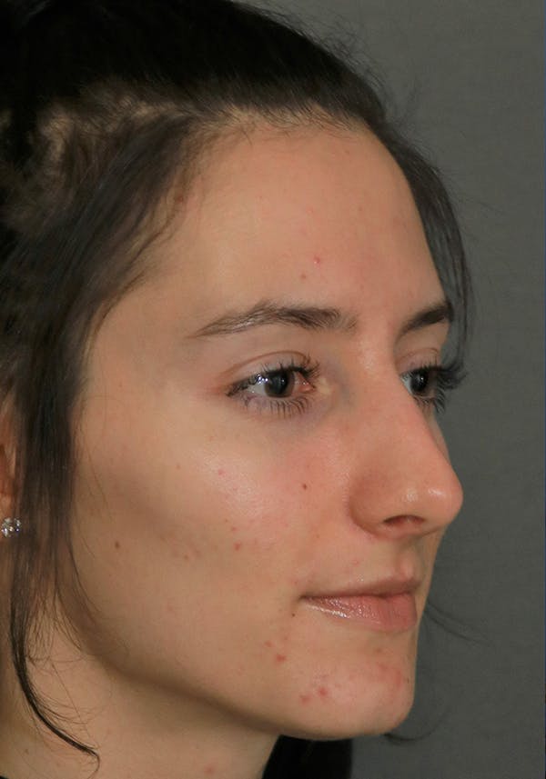 Aesthetic Rhinoplasty Before & After Gallery - Patient 14969149 - Image 3