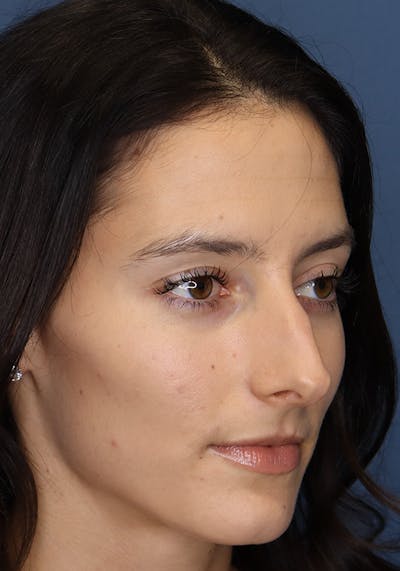 Aesthetic Rhinoplasty Before & After Gallery - Patient 14969149 - Image 4