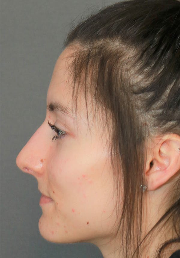 Aesthetic Rhinoplasty Before & After Gallery - Patient 14969149 - Image 5