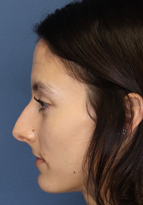 Aesthetic Rhinoplasty Before & After Gallery - Patient 14969149 - Image 6