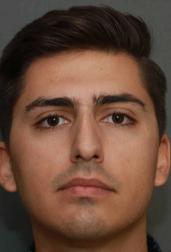 Revision Rhinoplasty Before & After Gallery - Patient 15239501 - Image 1