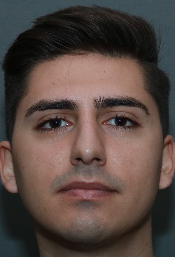 Revision Rhinoplasty Gallery - Patient 15239501 - Image 2