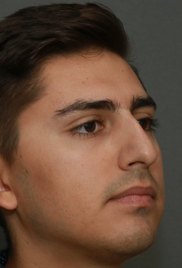 Revision Rhinoplasty Before & After Gallery - Patient 15239501 - Image 3