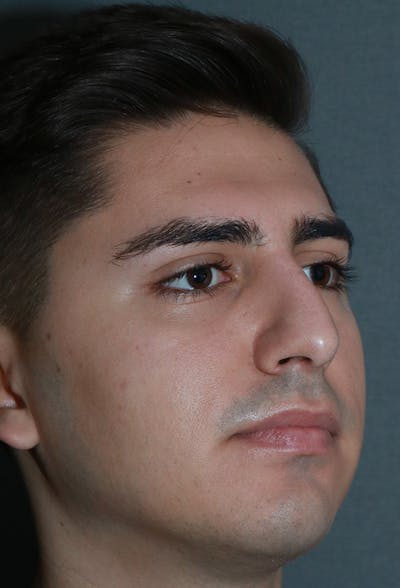 Revision Rhinoplasty Before & After Gallery - Patient 15239501 - Image 4