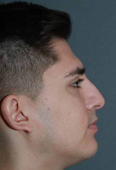 Revision Rhinoplasty Before & After Gallery - Patient 15239501 - Image 6