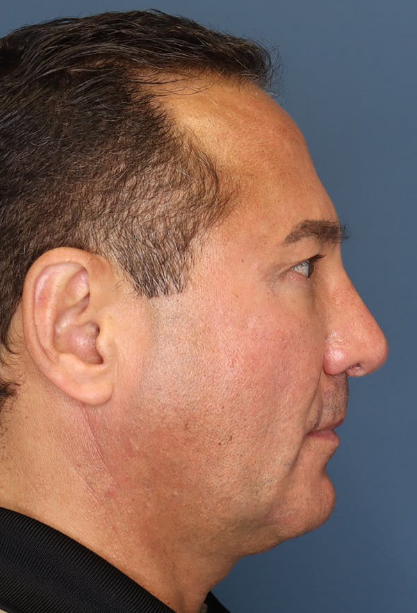 Revision Rhinoplasty Before & After Gallery - Patient 18427125 - Image 10