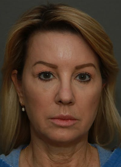 Facelift Before & After Gallery - Patient 21364537 - Image 1