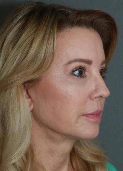 Facelift Before & After Gallery - Patient 21364537 - Image 4