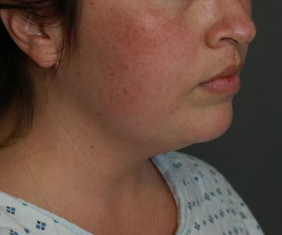Double Chin (Submental Liposuction) Before & After Gallery - Patient 25775851 - Image 1