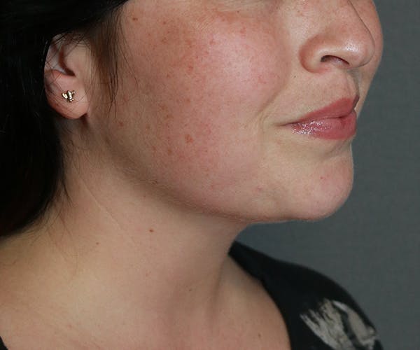 Double Chin (Submental Liposuction) Before & After Gallery - Patient 25775851 - Image 2
