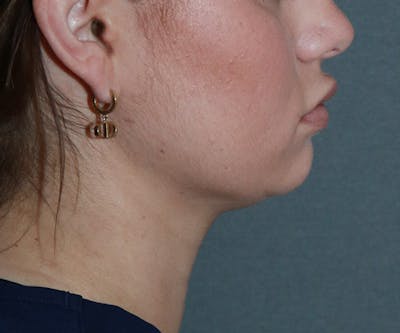 Double Chin (Submental Liposuction) Before & After Gallery - Patient 25775850 - Image 4