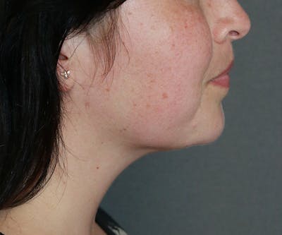Double Chin (Submental Liposuction) Before & After Gallery - Patient 25775851 - Image 4