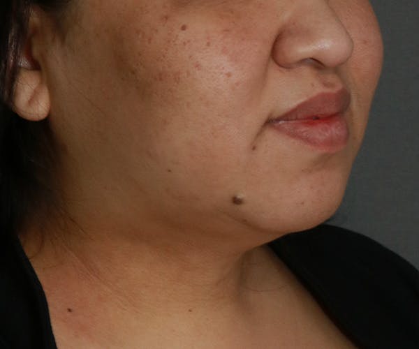 Double Chin (Submental Liposuction) Before & After Gallery - Patient 25775852 - Image 2