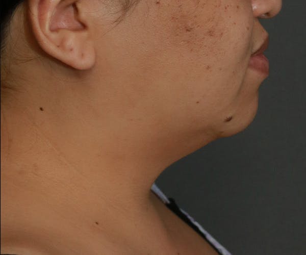 Double Chin (Submental Liposuction) Before & After Gallery - Patient 25775852 - Image 3