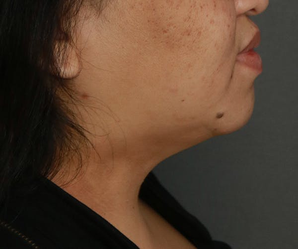 Double Chin (Submental Liposuction) Before & After Gallery - Patient 25775852 - Image 4
