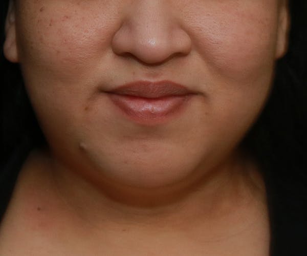 Double Chin (Submental Liposuction) Before & After Gallery - Patient 25775852 - Image 6