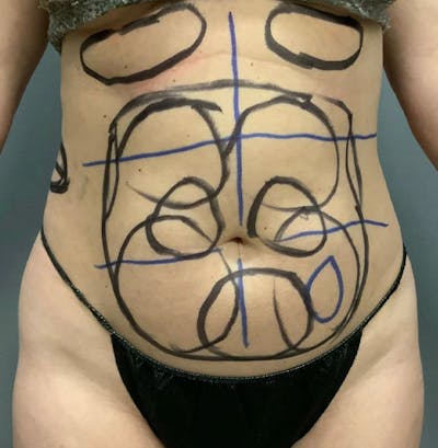 Microcannula Liposuction Before & After Gallery - Patient 26868844 - Image 1