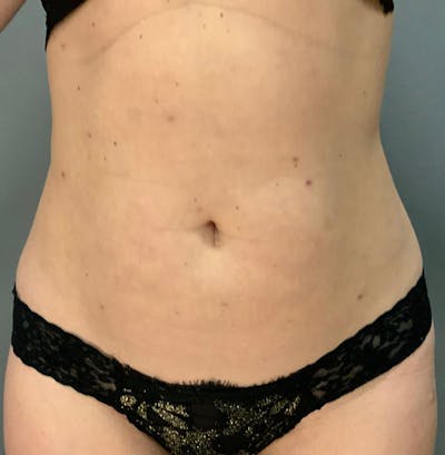 Microcannula Liposuction Before & After Gallery - Patient 26868844 - Image 2