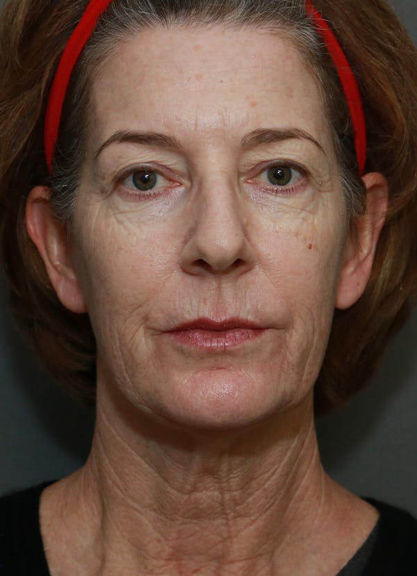 Facelift Before & After Gallery - Patient 31730255 - Image 1