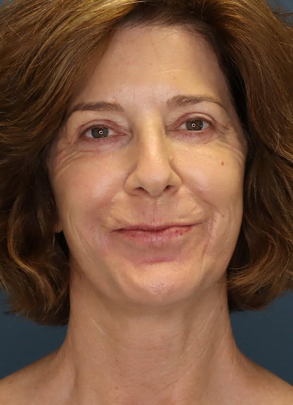 Facelift Before & After Gallery - Patient 31730255 - Image 2