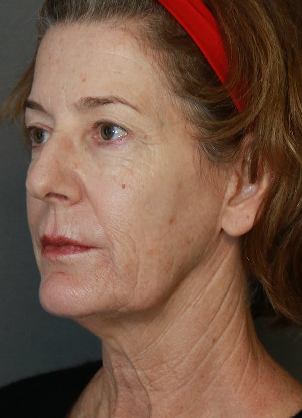 Facelift Before & After Gallery - Patient 31730255 - Image 3