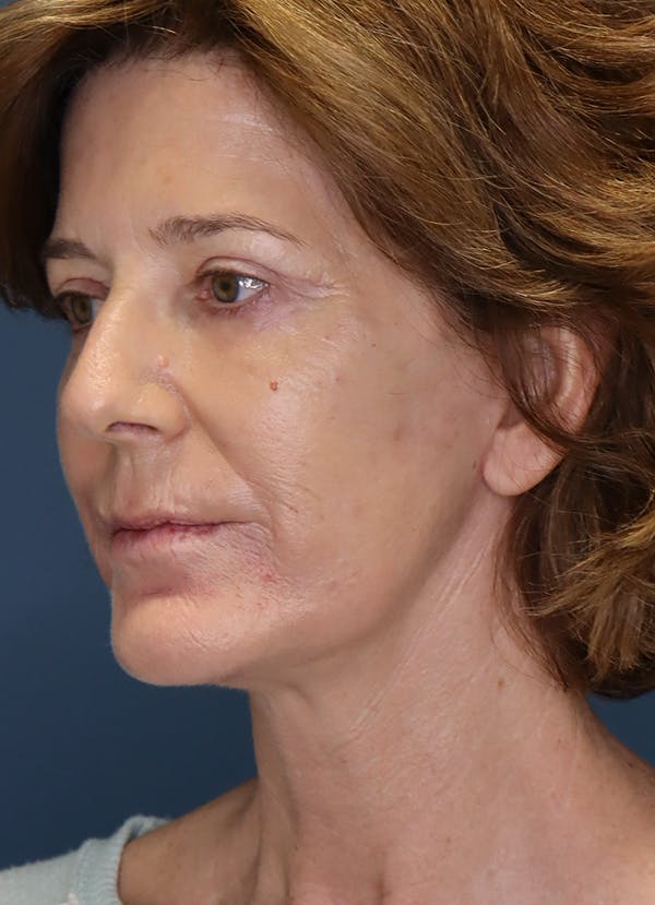 Facelift Before & After Gallery - Patient 31730255 - Image 4