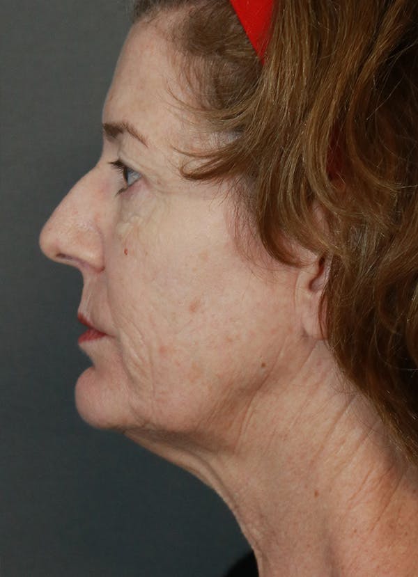 Facelift Before & After Gallery - Patient 31730255 - Image 5