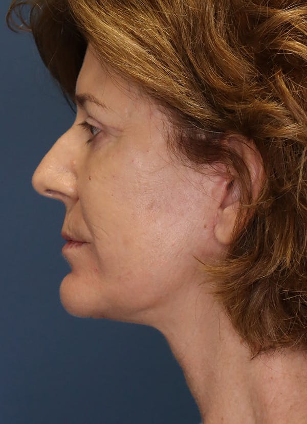 Facelift Before & After Gallery - Patient 31730255 - Image 6
