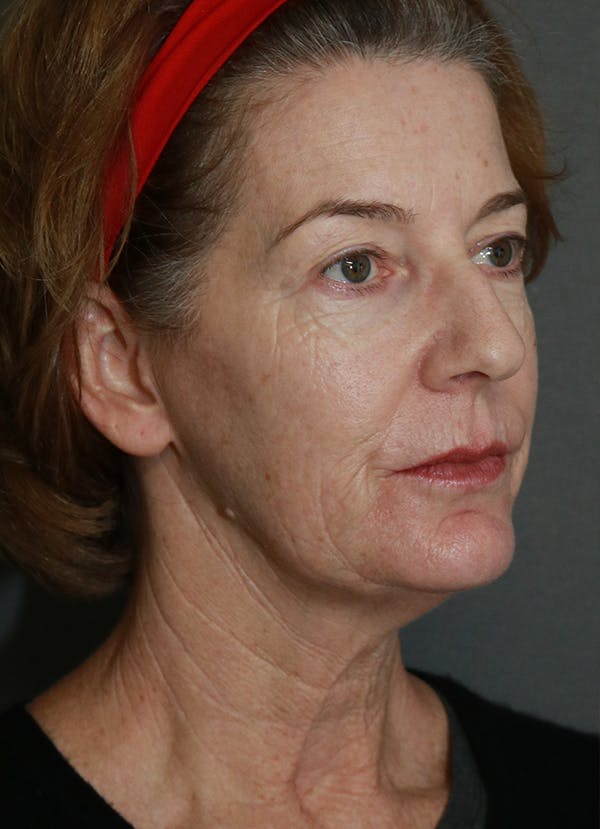Facelift Before & After Gallery - Patient 31730255 - Image 7