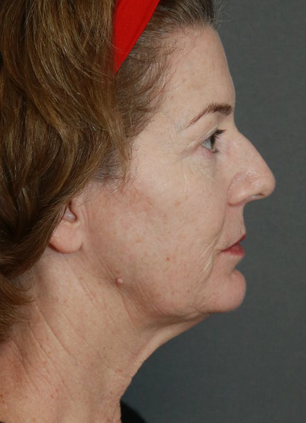 Facelift Before & After Gallery - Patient 31730255 - Image 9