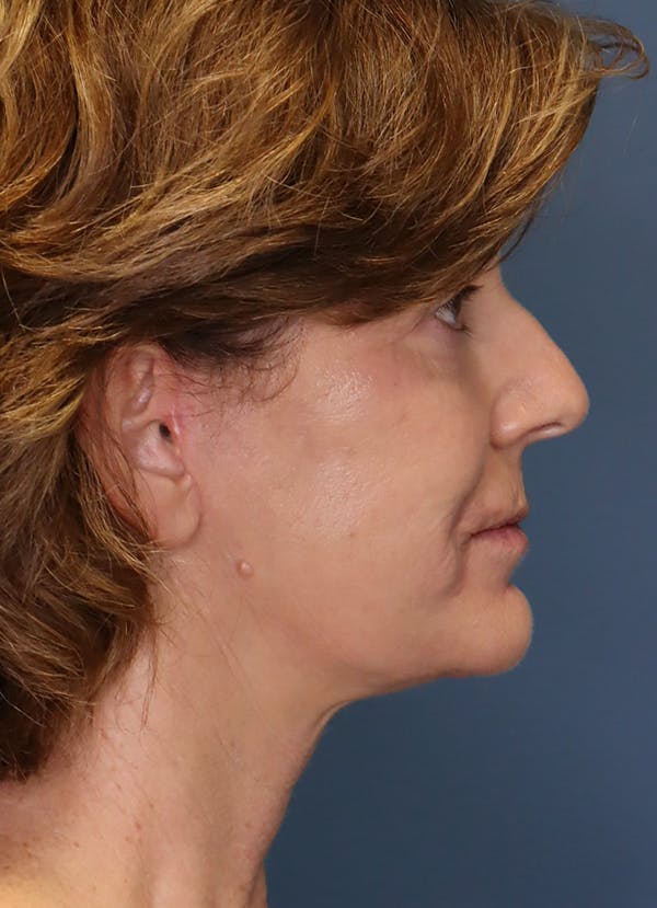 Facelift Before & After Gallery - Patient 31730255 - Image 10